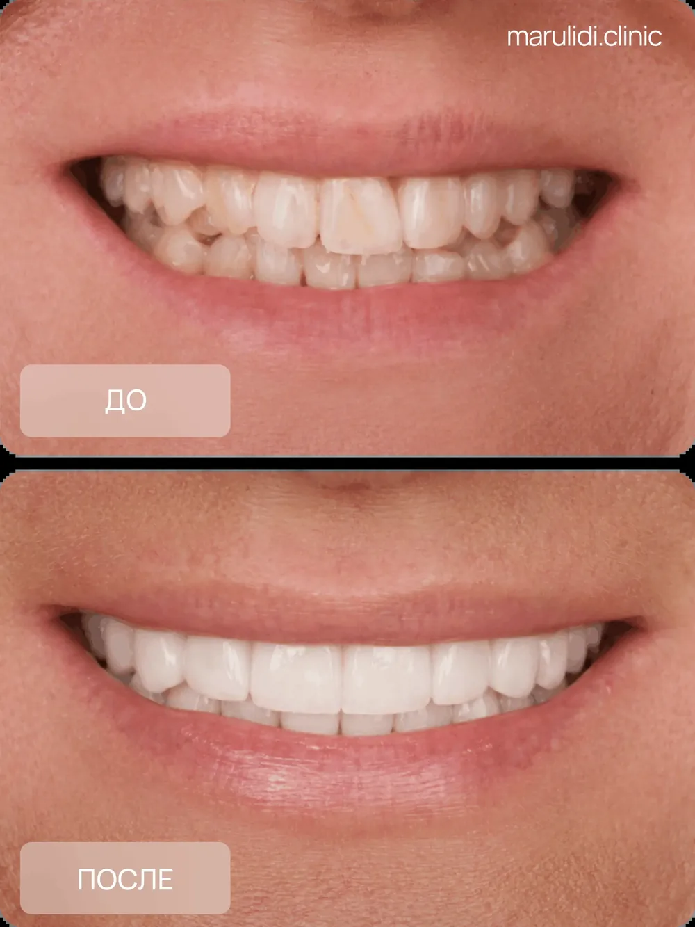 Улыбка пациента MARULIDI CLINIC до и после лечения